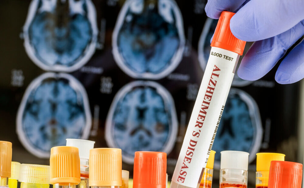 Organoidi cerebrali e ricerca sull'Alzheimer