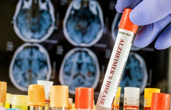 Organoidi cerebrali e ricerca sull'Alzheimer